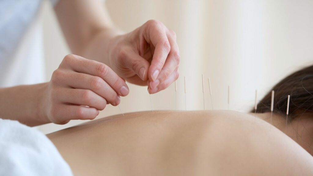 Akupunktura w leczeniu bezsenności 2