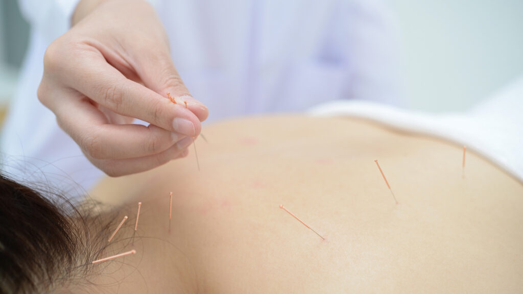 Akupunktura w leczeniu bezsenności 1